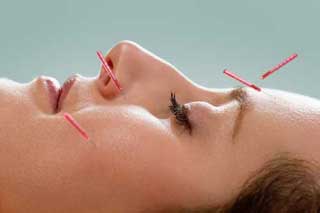 Woman laying on her back having Cosmetic, facial acupuncture 