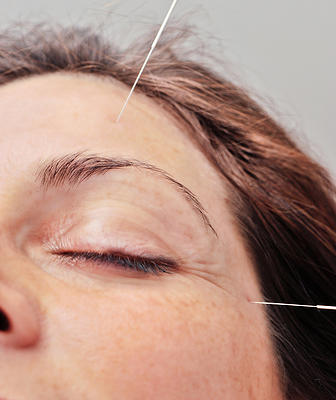 woman getting cosmetic acupuncture around the eyes in cordova tn